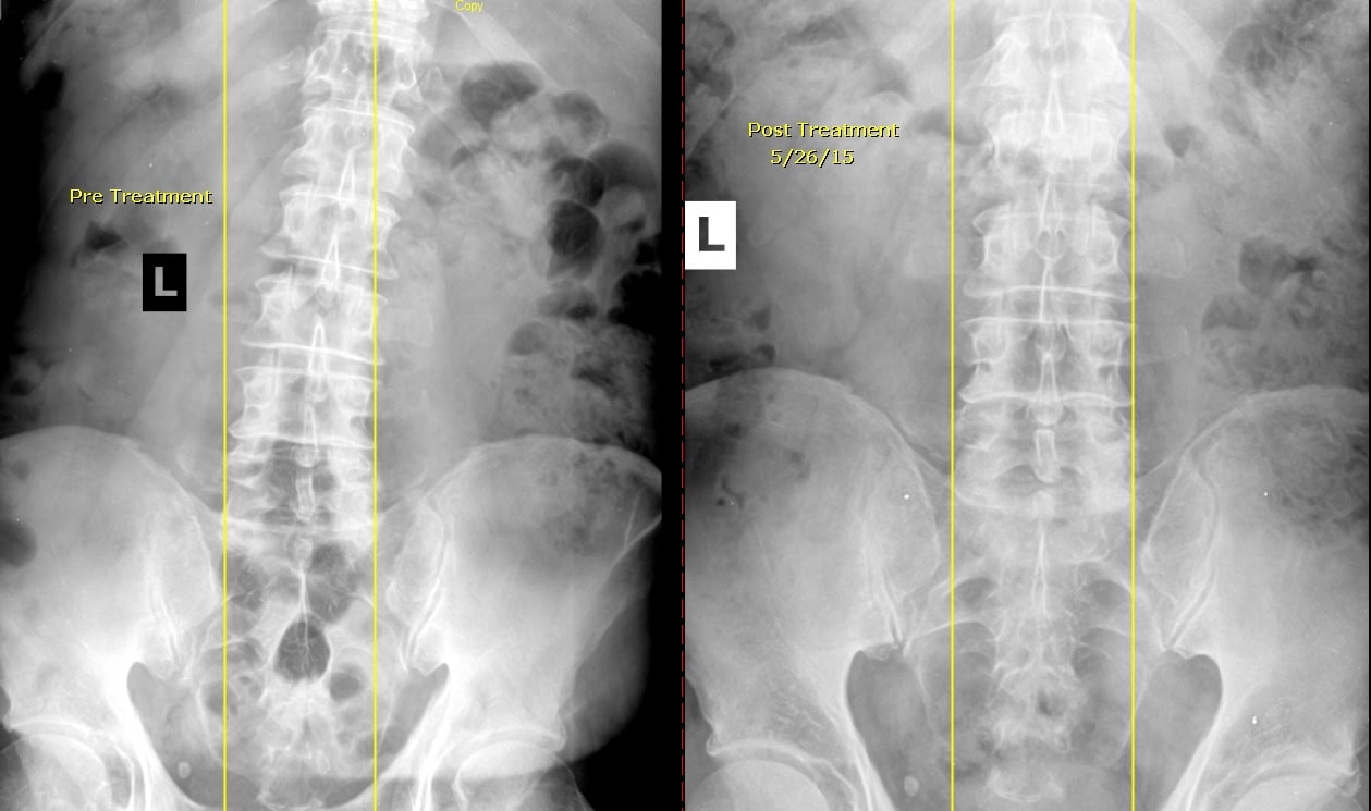 x-quang đau thắt lưng