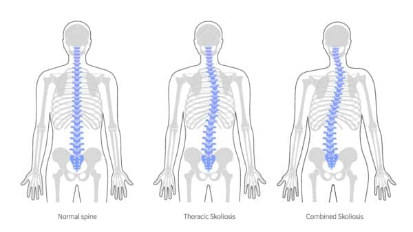 cong vẹo cột sống ở người trưởng thành
